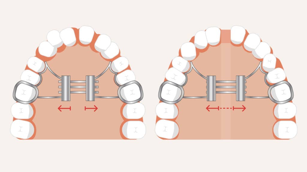 Diagram of palatal expanders used for widening the upper jaw in Scottsdale, AZ orthodontic treatment.
