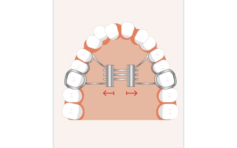 Illustration of palatal expanders used for widening the upper jaw in Scottsdale, AZ orthodontic treatment.