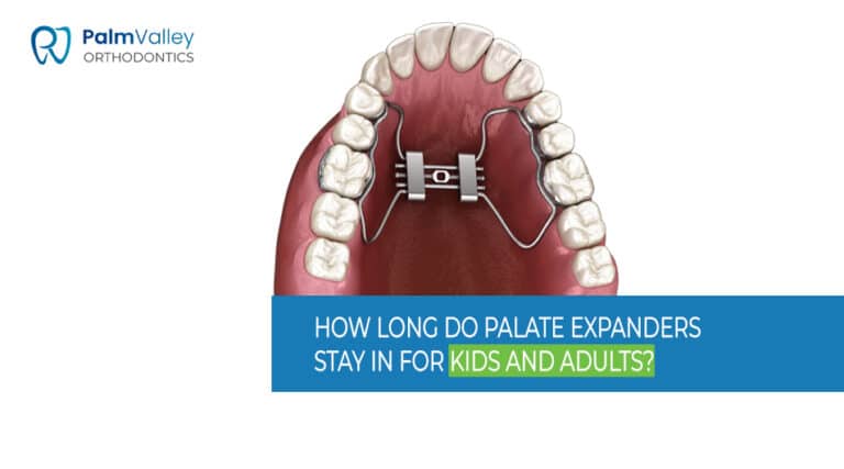 image of palatal expansion showing how long expanders stay in for all ages