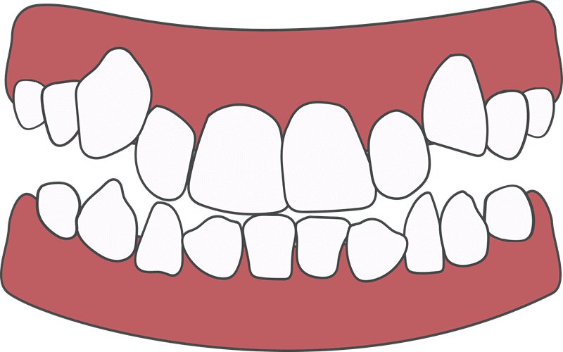 Orthodontic crowding and bite problems caused by abnormal tooth eruption