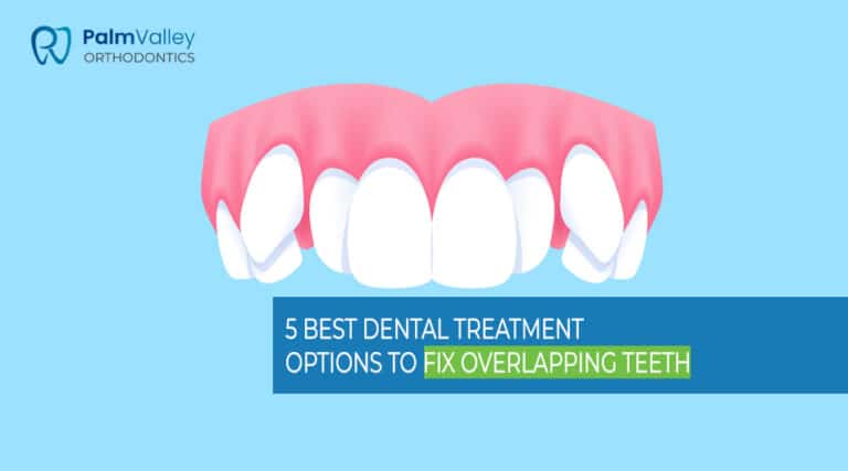 Close-up of overlapping teeth before orthodontic treatment